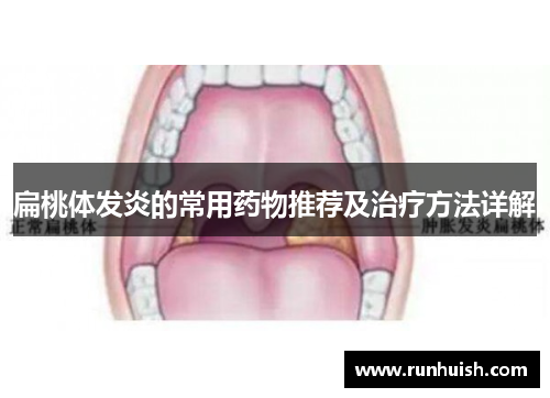 扁桃体发炎的常用药物推荐及治疗方法详解